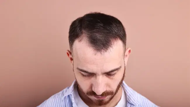 Alopecia androgenetica: cause, sintomi e cura