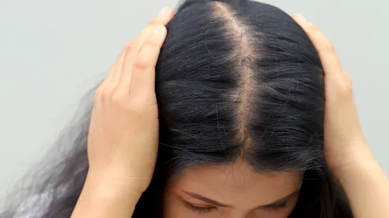 Alopecia androgenetica femminile: come riconoscerla e curarla