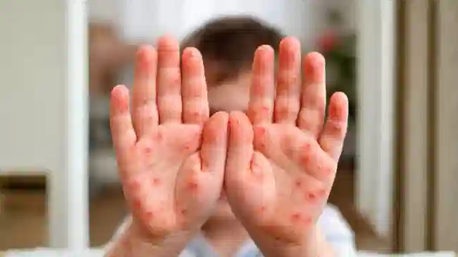 Malattia mani bocca piedi: sintomi, contagio e cura
