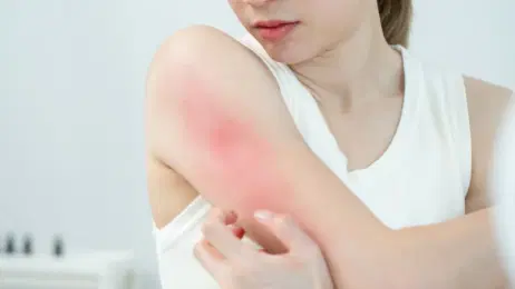 Pelle atopica: il ruolo di omega-3 e mediatori pro-risolutivi