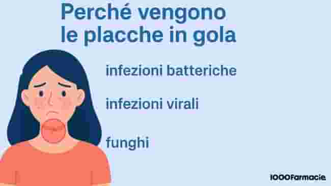 Placche in gola: cause, sintomi, farmaci e rimedi naturali per curarle