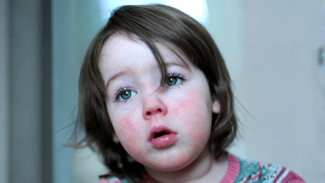 Scarlattina: sintomi, contagio e cura