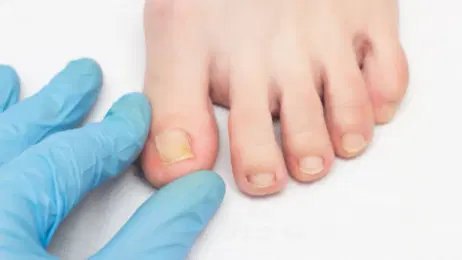 Unghie gialle: cause, trattamento e prevenzione