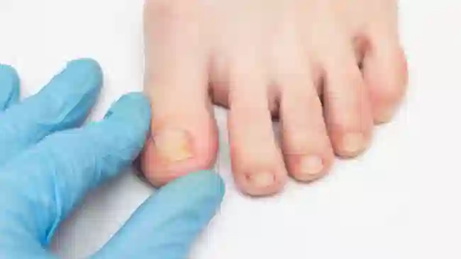 Unghie gialle: cause, trattamento e prevenzione