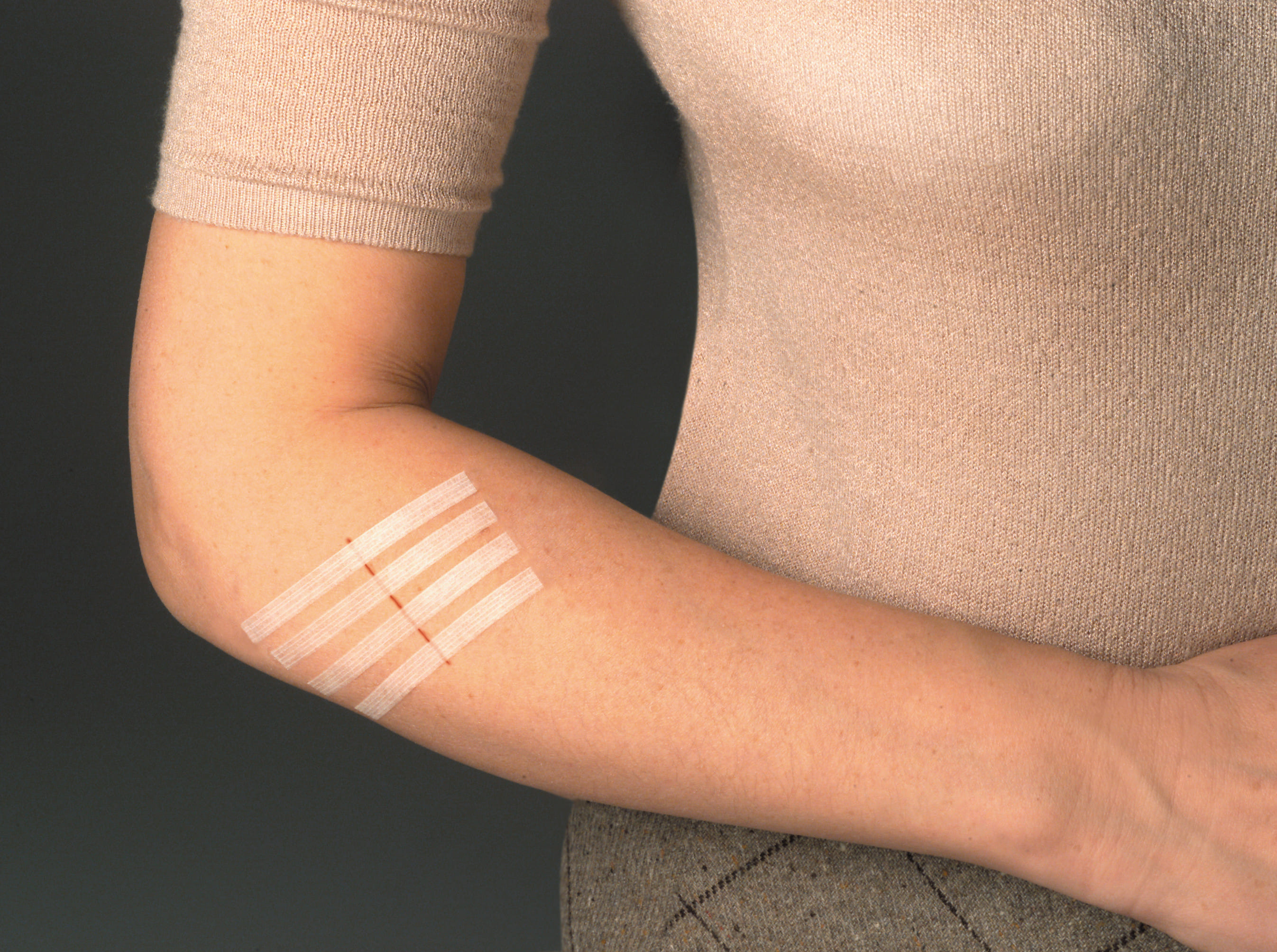 Cerotto sutura Nexcare Steri-Strip 6x75mm e 3x75mm