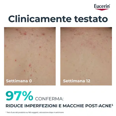 EUCERIN DERMOPURE CLINICAL CREMA CORPO TRIPLA AZIONE 200 ML EUCERIN DERMOPURE CLINICAL CREMA CORPO TRIPLA AZIONE 200 ML