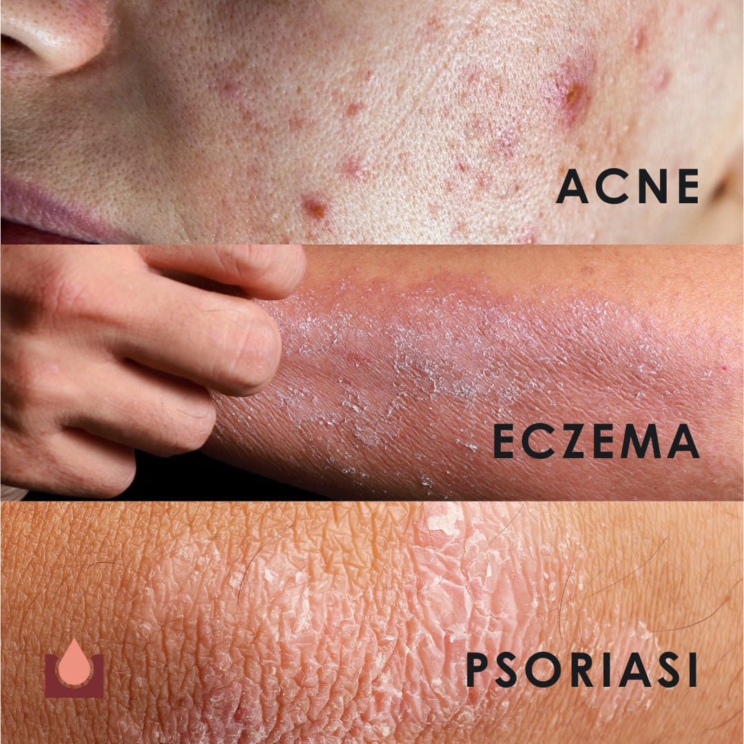 Eusphera Hemp cream Derma - Crema naturale per Psoriasi, Acne ed eczema